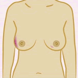 Diagram showing a lump