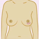 Diagram showing a change in skin texture