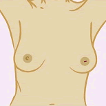 Diagram showing an inverted nipple